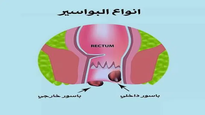 بشرى سارة للجميع: تعرف على علاج البواسير في